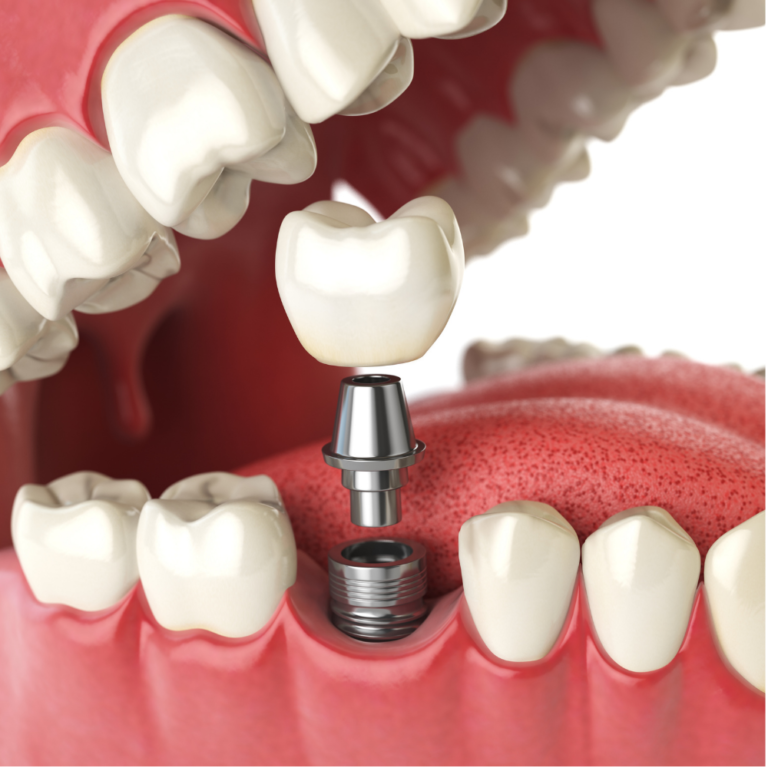 Dental implant restoration with precision-crafted ceramic crown