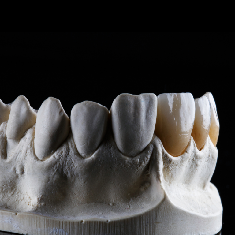 Precision-crafted zirconia dental crown with natural-looking aesthetics