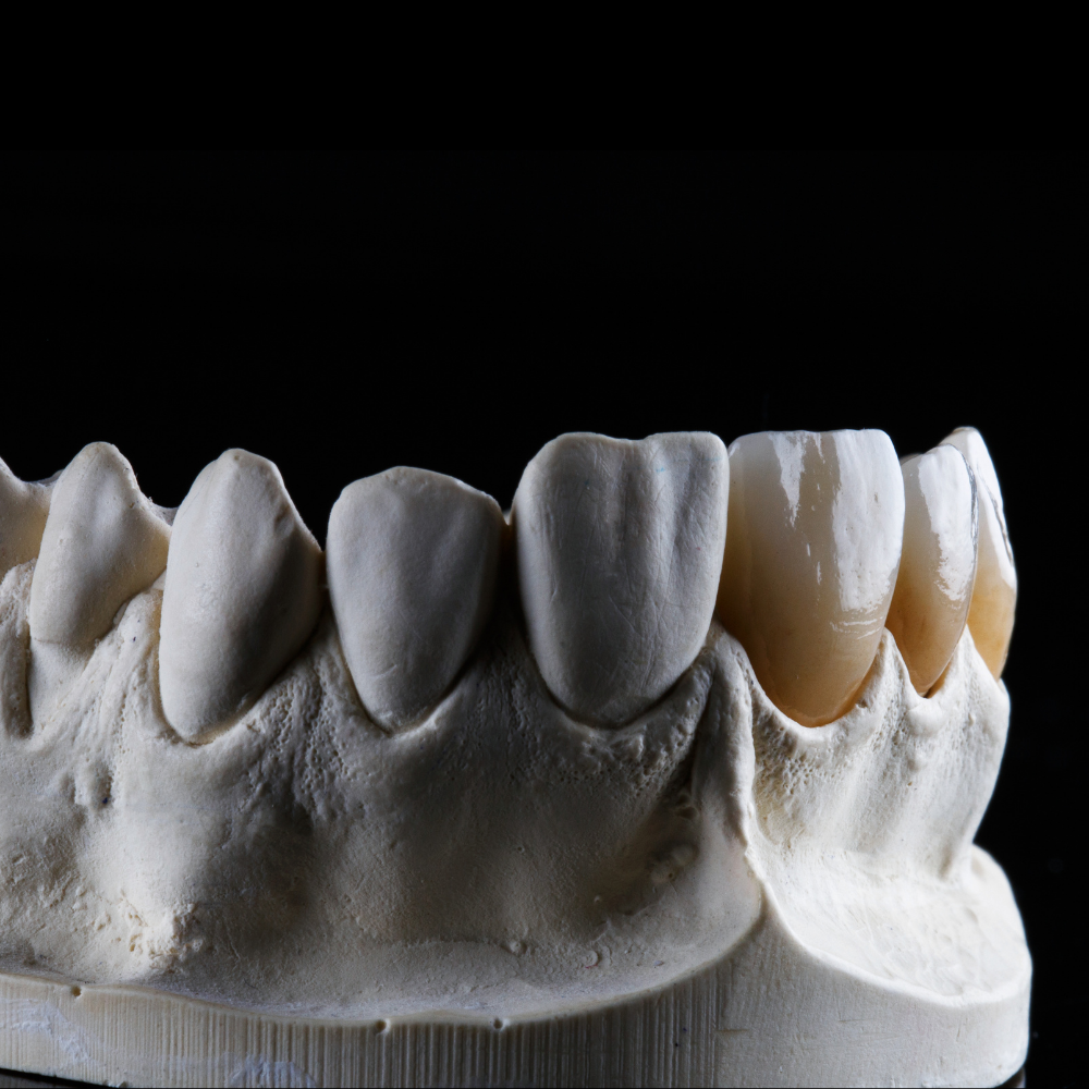 Precision-crafted zirconia dental crown with natural-looking aesthetics