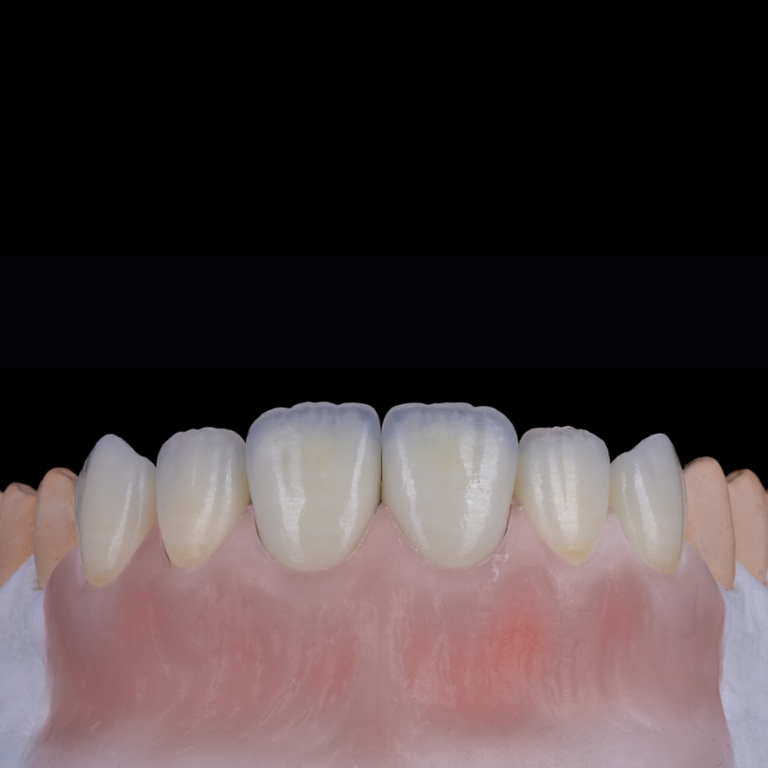 Feldspathic porcelain dental veneer with natural translucent aesthetics