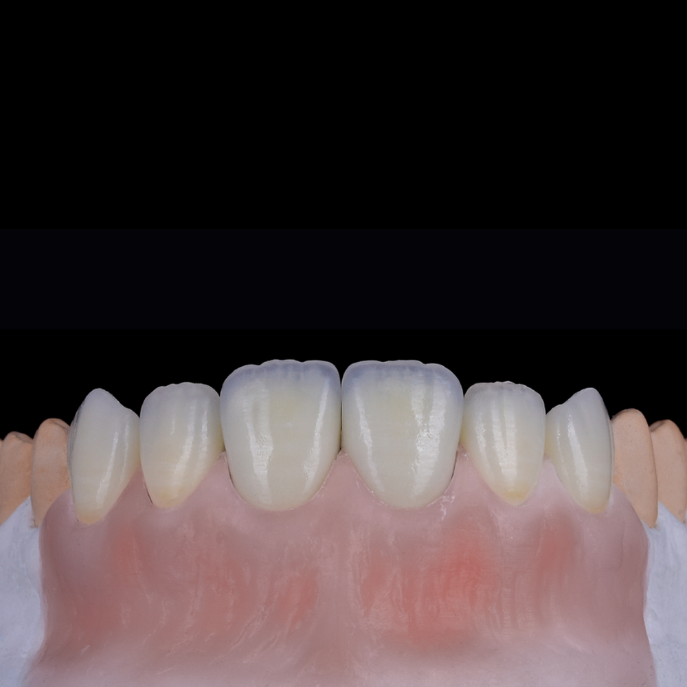 Feldspathic porcelain dental veneer with natural translucent aesthetics