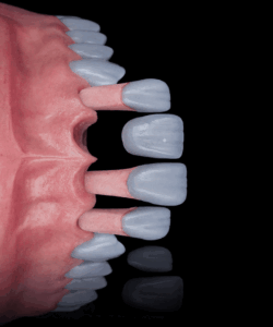 Advanced digital design and CAD/CAM technology ensure exceptional precision, accurate fit, and consistently high-quality dental restorations.