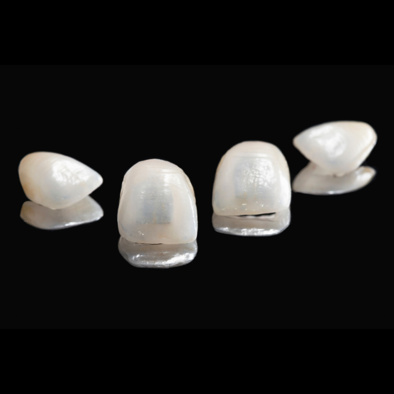 Natural-looking ceramic dental veneers with lifelike translucency